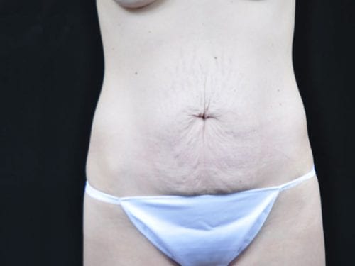 Tummy Tuck Patient 06 - Before 