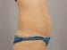 Tummy Tuck Patient 14 - After Thumbnail 