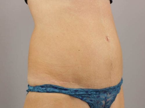 Tummy Tuck Patient 14 - After 