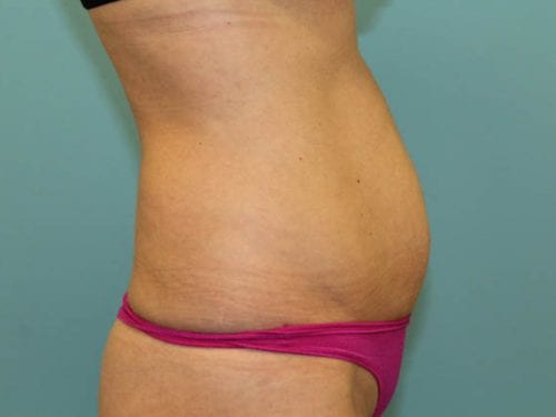 Tummy Tuck Patient 14 - Before 