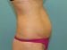 Tummy Tuck Patient 14 - Before Thumbnail 