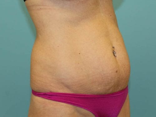 Tummy Tuck Patient 14 - Before 