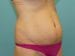 Tummy Tuck Patient 14 - Before Thumbnail 