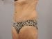 Tummy Tuck Patient 02 - After Thumbnail 
