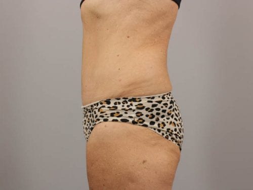 Tummy Tuck Patient 02 - After 